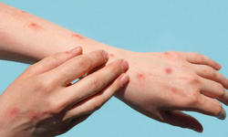 Maymun Çiçeği Yayılıyor: Alanya Alarmda