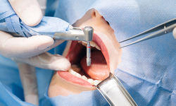 Kumluca'da Devlet Destekli İmplant Tedavisi İmkanı