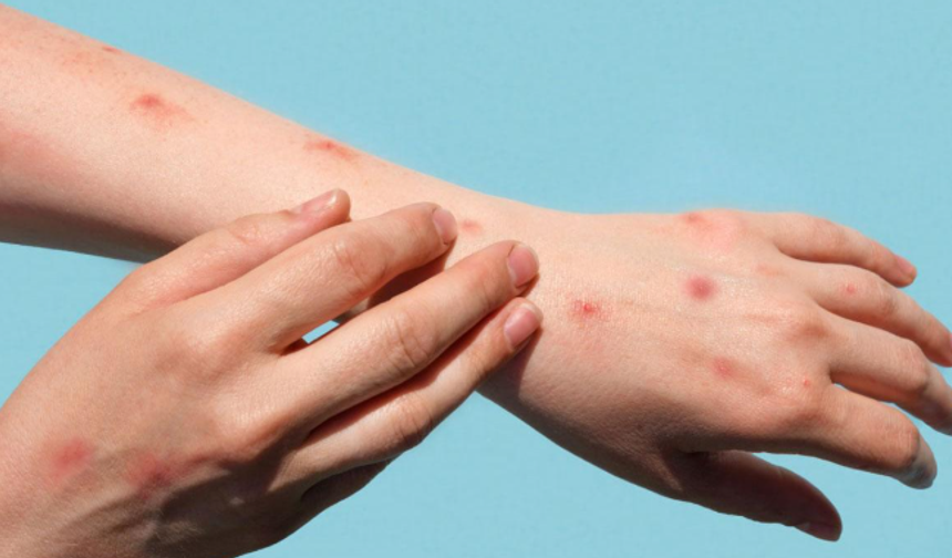 Maymun Çiçeği Yayılıyor: Alanya Alarmda